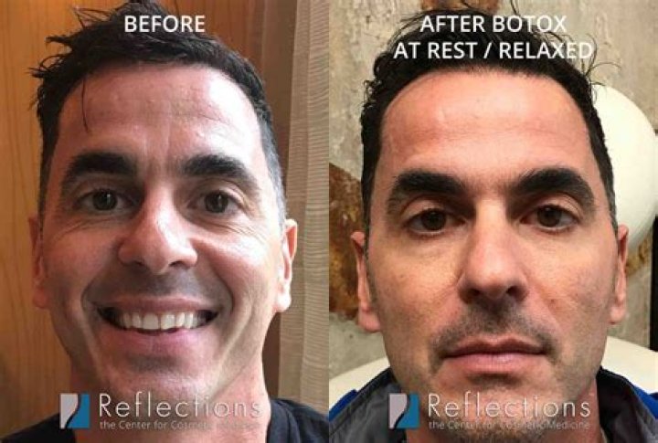 Botox Before And After Plastic Surgery Revelations