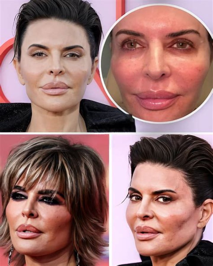 Lisa Rinna Before Surgery: A Deep Dive into Her Transformation