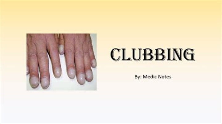 Understanding Clubitis Disease Symptoms in Adults: A Comprehensive Guide